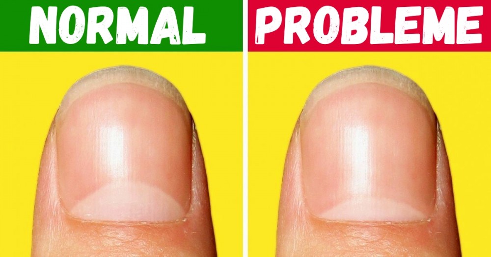 13 probleme de sănătate, pe care ni le dezvăluie forma semilunii de pe unghii